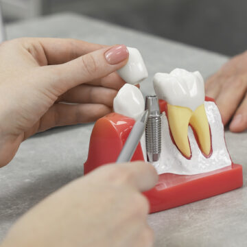 Reasons Why You Should Choose Dental Implants?