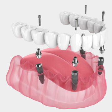 Main Concerns that Take Place After a Dental Implant